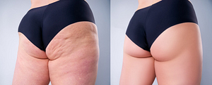 After QWO Cellulite Treatments butts look better than before.