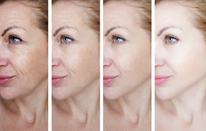 Viora skin tightening and Botox take years off your face