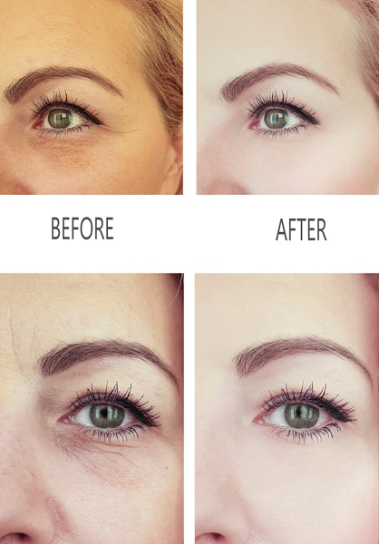 eye wrinkles before and after under eye filler 