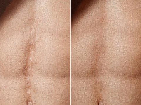 Scar reduction before and after on an abdomen 