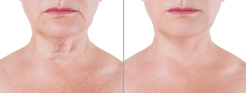Before and after nonsurgical necklift