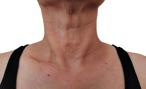 Get rid of flabby neck fat with the nonsurgical neck lift