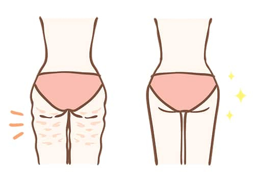 fat reduction on the buttocks