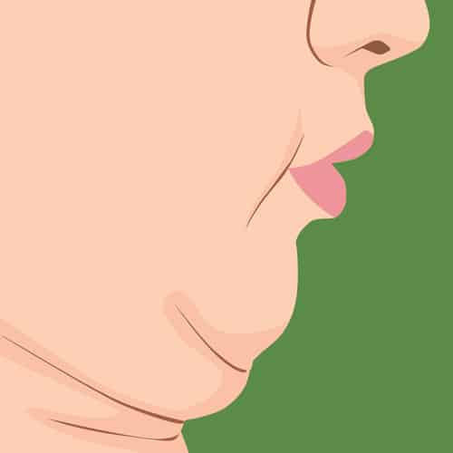 Double Chin can be eliminated by the nonsurgical neck lift
