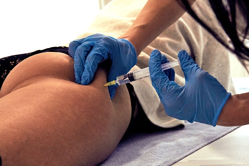 Sculptra Injections for a Nonsurgical Butt lift