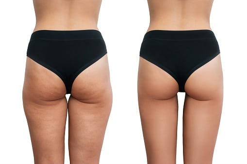 Before and After Nonsurgical butt lift: Tighter and Rounder Butts are the goal