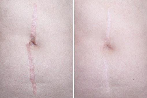 Before and after a vbeam and fraxel laser treatment on a torso