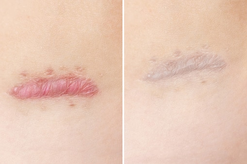 Before and after vbeam and fraxel laser treatment at Miami Skin Institute 