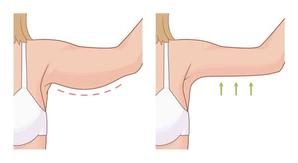 Illustration of arm fat before and after Kybella treatments