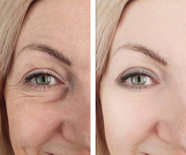 under eye filler before and after 