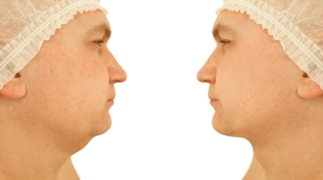 before and after kybella fat melting injections
