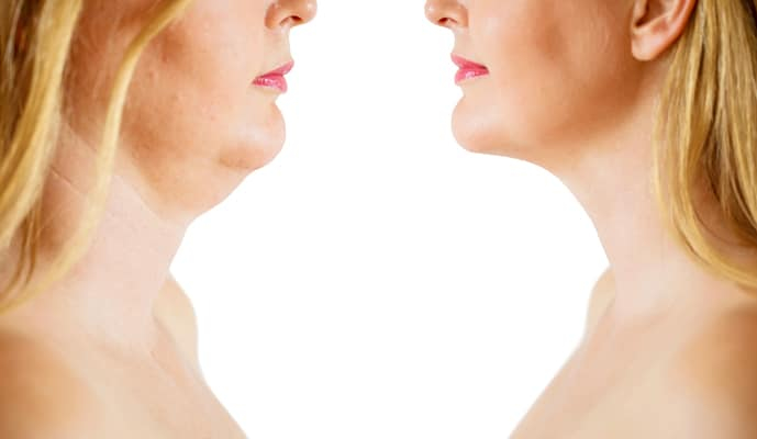 Woman's chin before and after Kybella treatments
