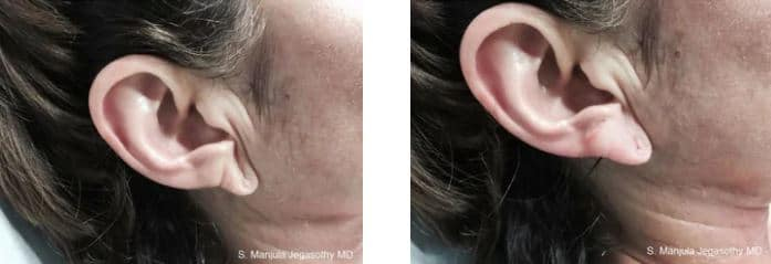 Before and after 1 treatment of Restylane® injected to plump earlobes.
