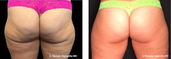 Before and After 12 Months Viora® Laser Treatment for Buttock Cellulite