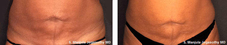 Before and After Viora® Laser Treatment for Abdomen