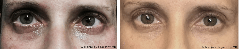 Best Fraxel® and Viora® Cosmetic Laser Combo Treatment for Eyelids