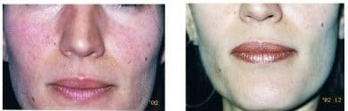 VBeam® Laser Treatment for Redness Rosacea Before and After 1 Month with 2 Treatments