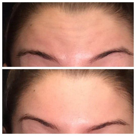 Botox Cosmetic® / Dysport® / Xeomin® to help shape brows and erase wrinkles