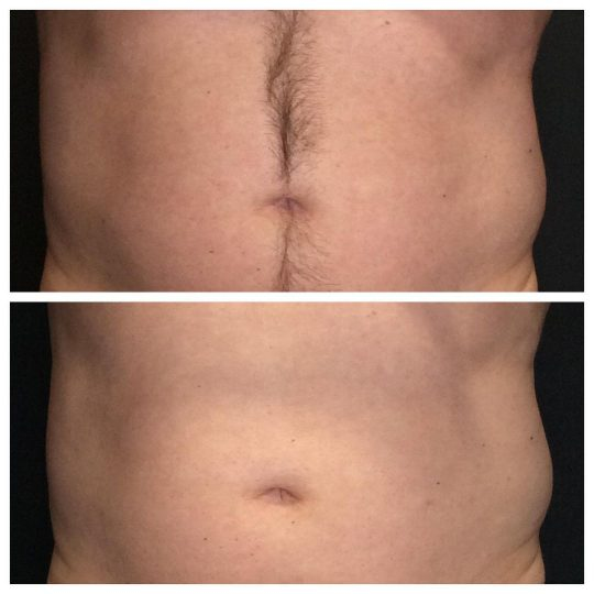 VanquishME™ Fat Melting laser treatments used to reduce love handles