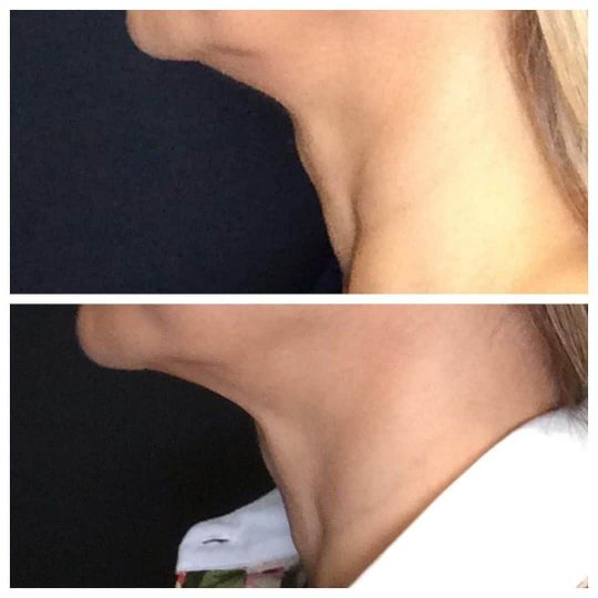Ultherapy®️ used for non-surgical necklift