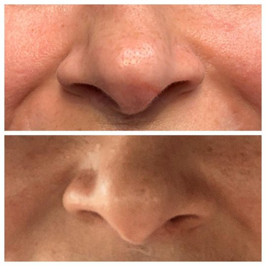 Botox® Cosmetic used to fix nasal deviations