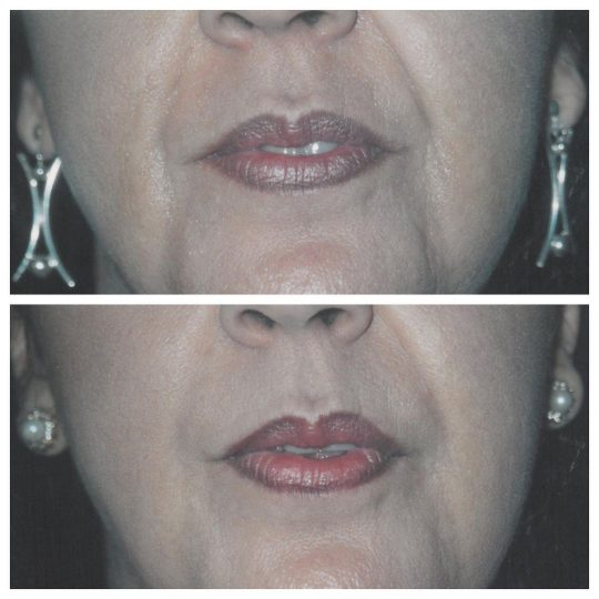 Facial Fillers used to fill facial creases and wrinkles