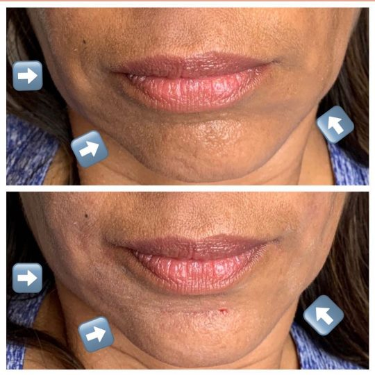 Facial Fillers used to fix facial symmetry