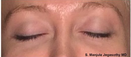 Post Viora® Radiofrequency Laser for Eyelid Skin Tightening
