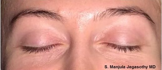 Pre Viora® Radiofrequency Laser for Eyelid Skin Tightening