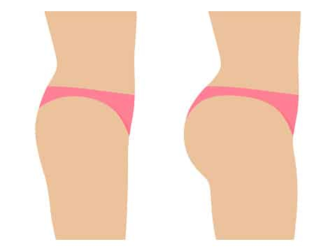 Before and After Illustrations of Nonsurgical Butt lift