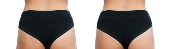 The Nonsurgical Butt Lift