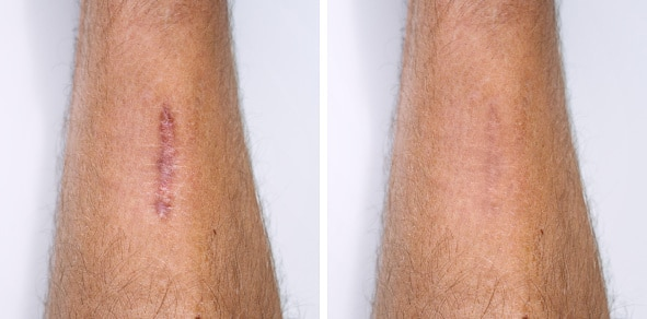 Vbeam and fraxel laser treatment before and after