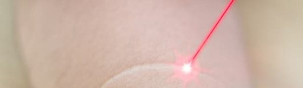 Vbeam and Fraxel Lasers:Scar Reduction (aka Scar Effacement aka Scar Erasure)