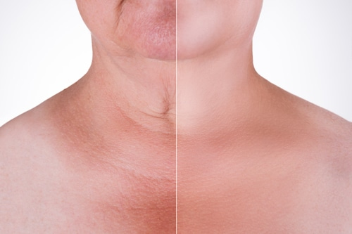 nonsurgical neck lift results before and after