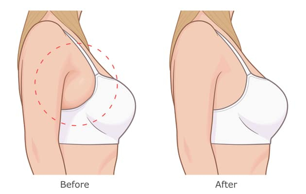 Illustration of before and after Kybella fat melting injections