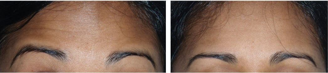Botox® Cosmetic for the forehead area