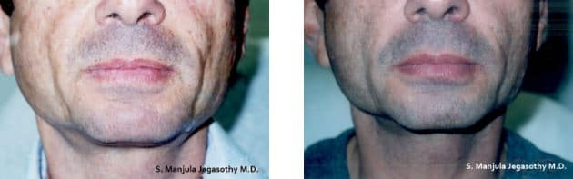 Sculptra® for the cheeks on a 55 year old man
