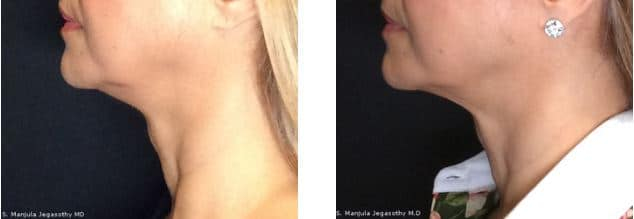 Ulthera ® neck skin tightening on 55 - 64 year old woman
