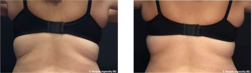 VanquishME™ for Reducing Back Fat