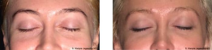 Viora® Radiofrequency Laser for Eyelid Skin Tightening