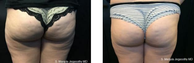 Viora® Radiofrequency Laser on the buttocks area
